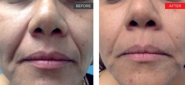 Face lift results