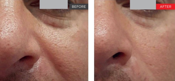 Jowl tightening results